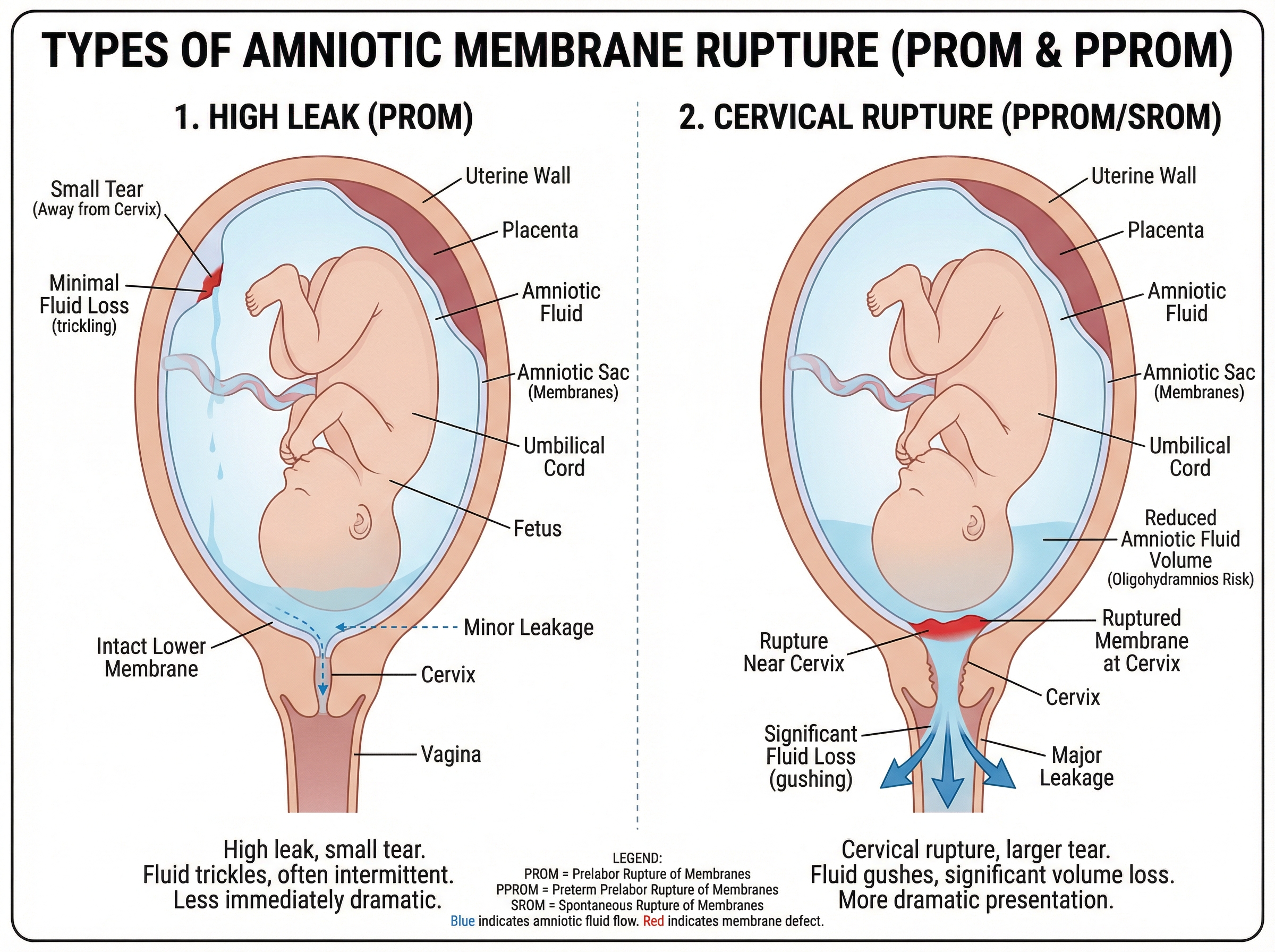 Amniotic Rupture
